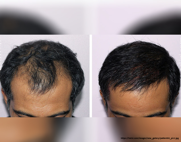 Permanent-Effect-of-Getting-Hair-Back-With-The-Hair-Transplantation