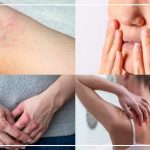 eczema causes and treatment