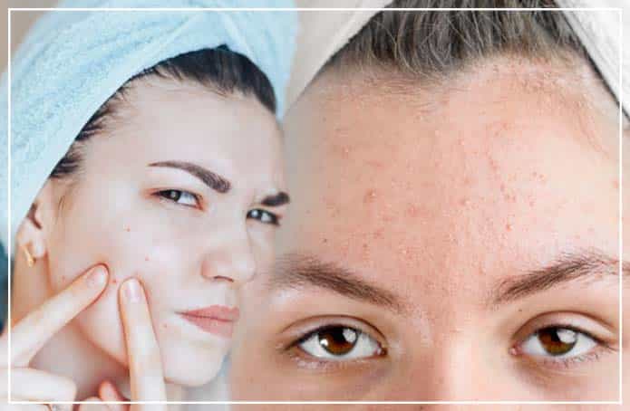 Pimples or Acne during PMS