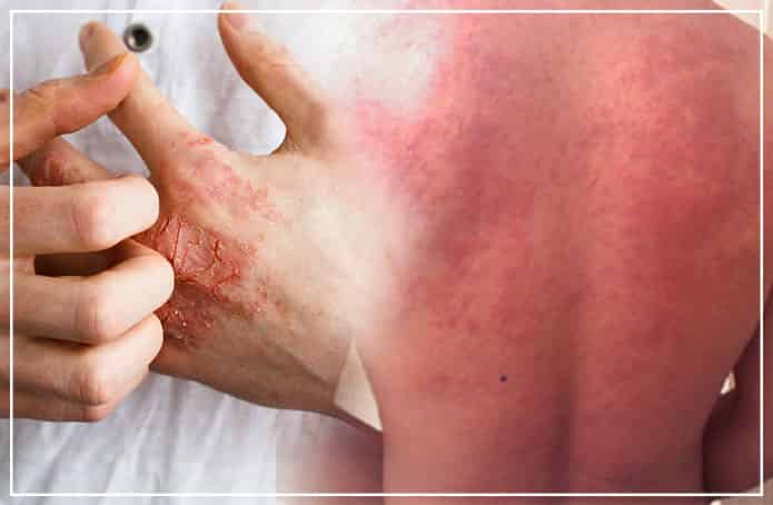scabies home treatment