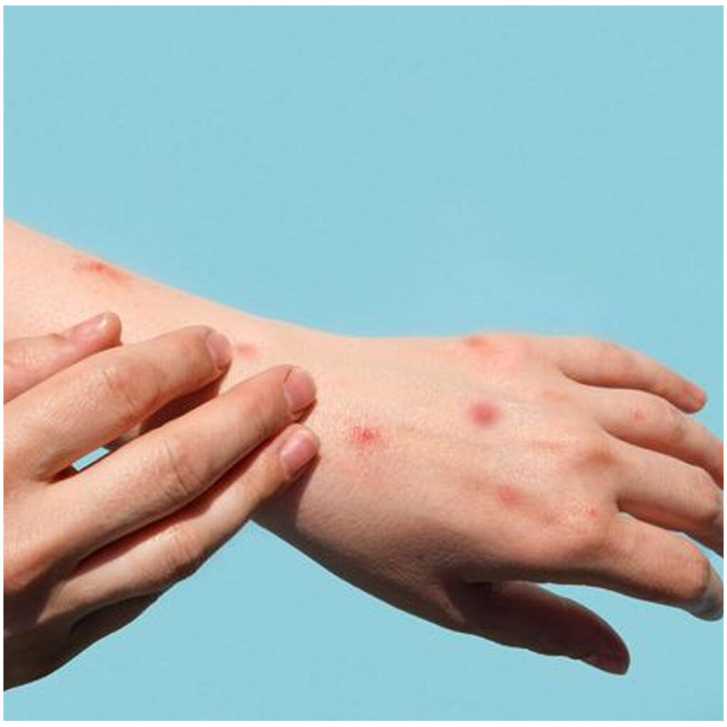 Mpox
